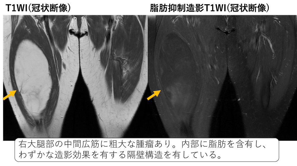 異型脂肪様腫瘍(ALT)、高分化脂肪肉腫(WDL)のMRI画像所見のポイント